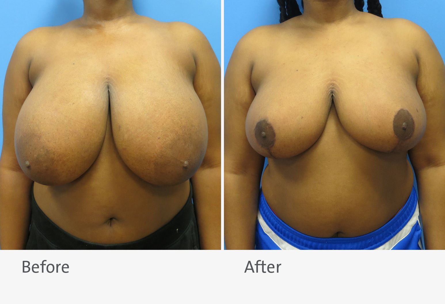 A patient is shown before and after a breast reduction. On the left is the patient before the surgery with very large breasts and on the right is the patient after surgery with smaller breasts.